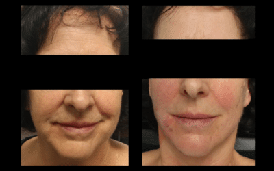 Non-Surgical Face Lift