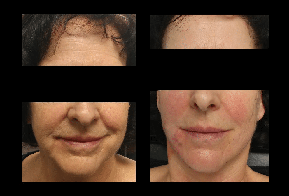 Non-Surgical Face Lift