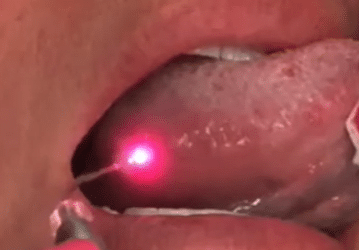 Lasers in Dentistry – Laser that Canker Sore!