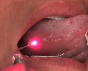 Lasers in Dentistry – Laser that Canker Sore!